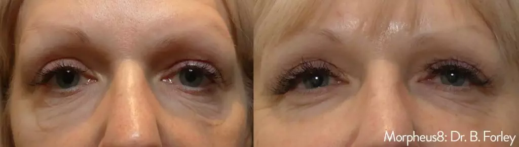 Morpheus 8 Dr. Forley Before & After image