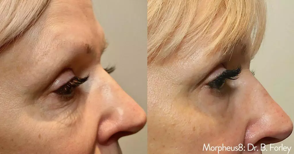 Morpheus 8 Dr. Forley Before & After image