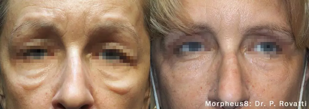 Morpheus 8 Dr. Rovatti Before & After image